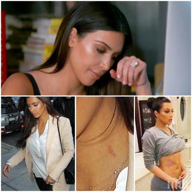ПОТРЕС! Ким Кардашиян разкри, че страда от коварно заболяване (СНИМКИ)