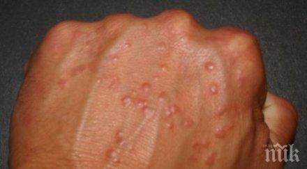 алергиите отключват зимата