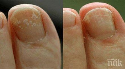 внимание ноктите издават сърдечни проблеми увреда щитовидната жлеза псориазис