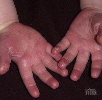 Нова зараза, този път от скарлатина