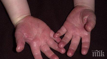 нова зараза път скарлатина