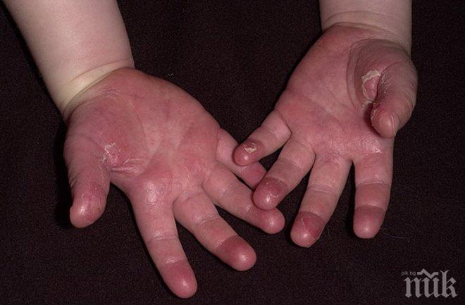 Нова зараза, този път от скарлатина