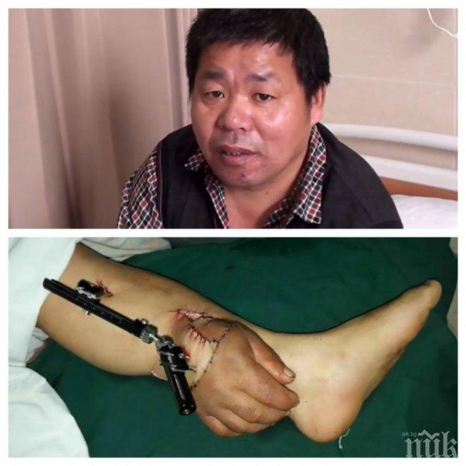 УНИКАЛНА ОПЕРАЦИЯ: В Китай спасиха отрязана китка на мъж, като я пришиха към крака му