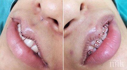 нова тенденция подлуди жените козметична процедура прави устните