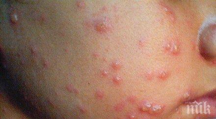 болест варицелата налази пазарджик тръшна души седмица