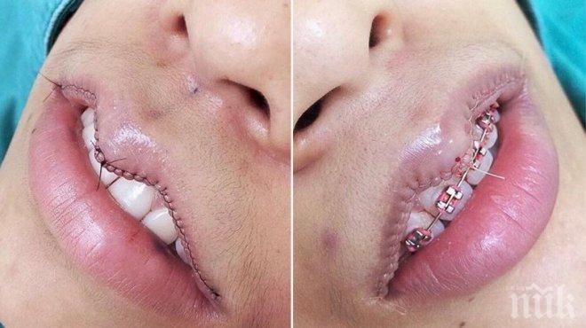 Нова тенденция подлуди жените, тази козметична процедура прави устните им ...