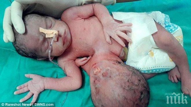УНИКАЛНО! В Индия се роди дете с две глави и три ръце (СНИМКА 18+)