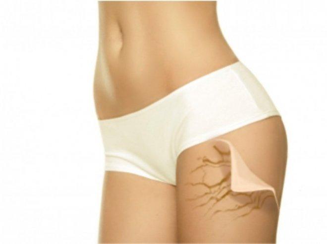 ВНИМАНИЕ, ДАМИ! Има сила срещу стриите - ето рецептата