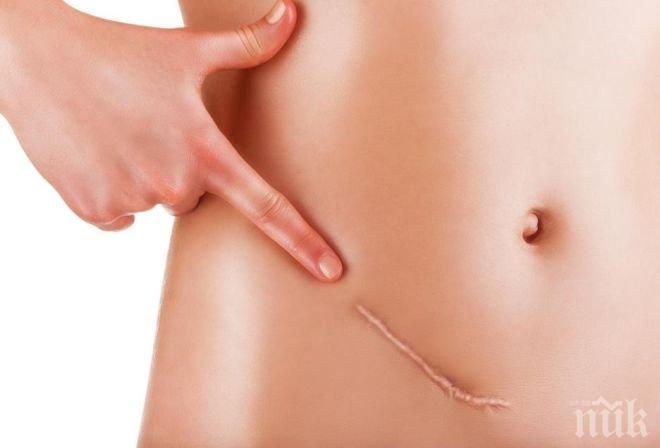 Учени изобретиха ново лепило срещу белези