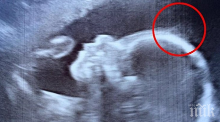 лекарите забелязали странни очертания снимката ултразвука бъдещата майка също остана изумена