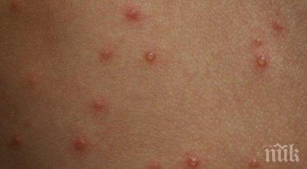 зараза варицела налази варна случая седмица