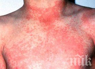 ВНИМАНИЕ! Скарлатина и варицела налазват Габрово