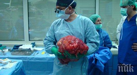 часова операция извадиха огромен тумор корема жена