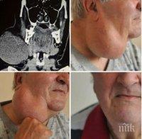 Медиците във ВМА отстраниха огромен тумор от шията на мъж (СНИМКА)