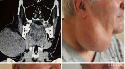 медиците вма отстраниха огромен тумор шията мъж снимка