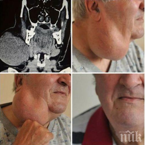 Медиците във ВМА отстраниха огромен тумор от шията на мъж (СНИМКА)