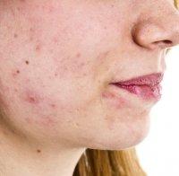 Ето как да изчистите акнето без остатък