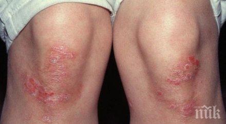 пробив убиват псориазиса клетъчна терапия