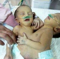 Състоянието на сиамските близнаци от Сливен се влошава