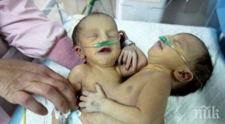 състоянието сиамските близнаци сливен влошава