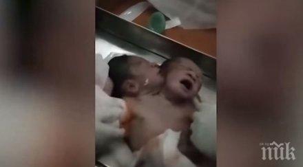 аномалия индия роди бебе две глави видео