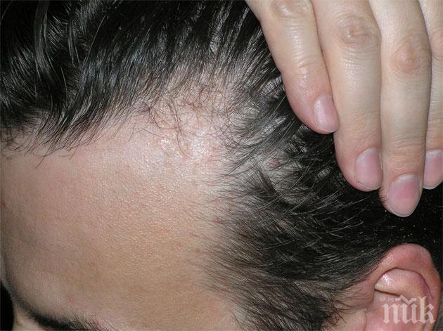 Гъбичките се появяват първо в косата