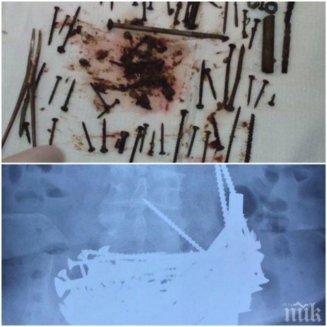 Руски лекари извадиха над 150 метални предмета от стомаха на баба