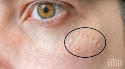 начина отървете милиумите завинаги