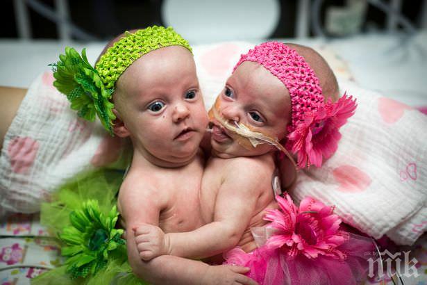 Вижте успешно разделените от 75 лекари сиамски близначки (СНИМКИ)