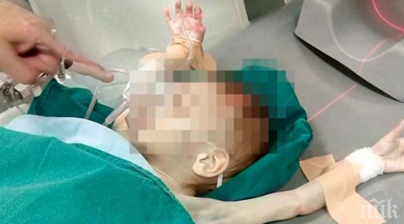 ДОБРА НОВИНА! Пребитото близначе от Пловдив излезе от кома