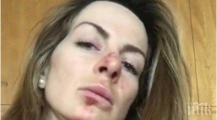 сани жекова падна тежко извади рамо охлузи лицето снимка