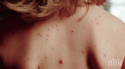 бум варицела пловдив