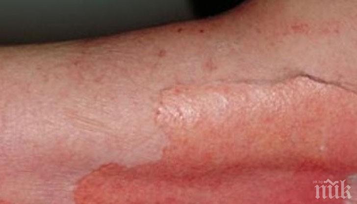 Опасно! Нараства броят на пациентите със злокачествени образувания на кожата в Русе