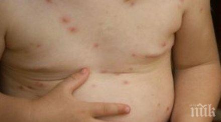 бум варицела скарлатина страната