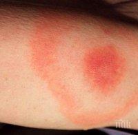 ВНИМАНИЕ! Лекари бъркат лаймската болест с летен грип - заразата води до тежки усложнения