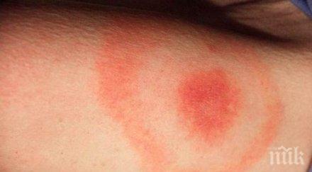 внимание лекари бъркат лаймската болест летен грип заразата води тежки усложнения