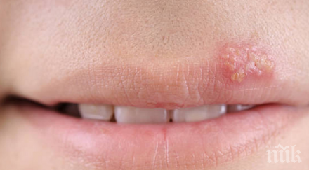 важно избавите херпеса