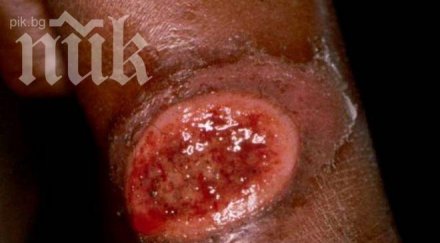 болни дум дум треска