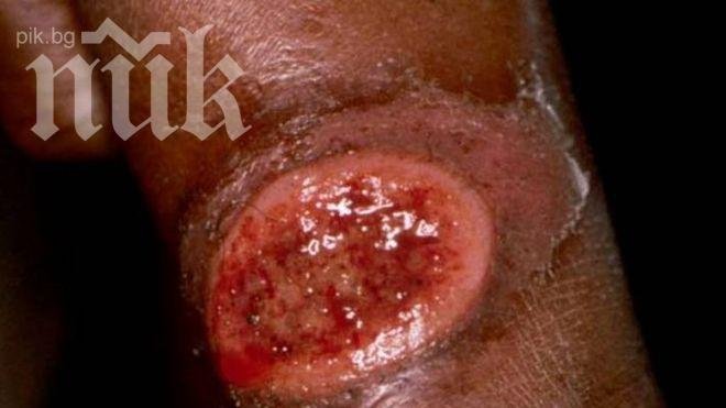 Нови болни от дум-дум треска