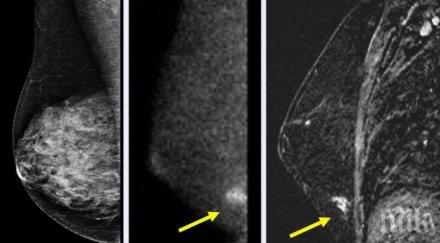 шок всяка трета българка напреднал рак гърдата