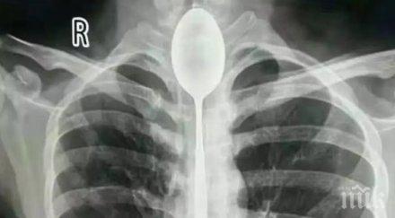 китаец живял година лъжица стомаха