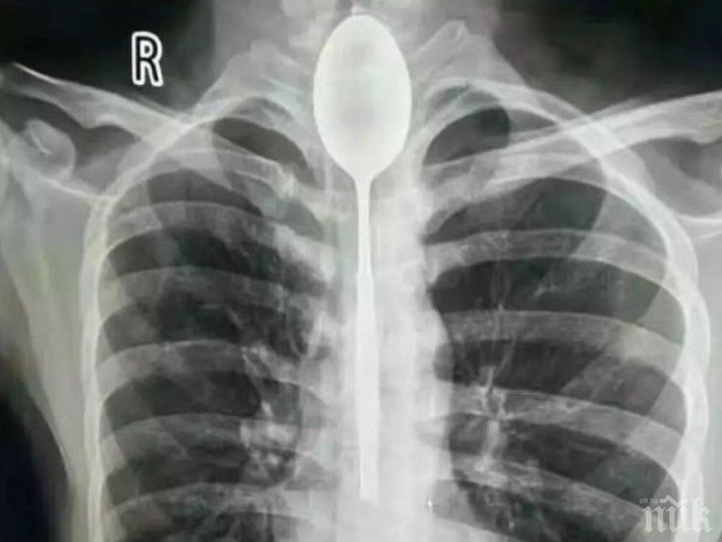 Китаец живял година с лъжица в стомаха
