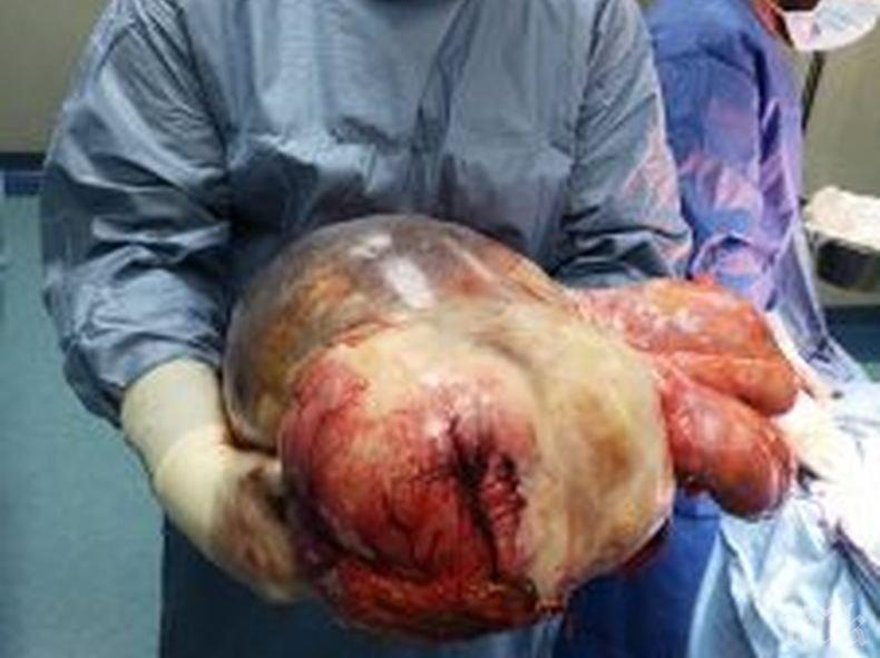 Шефът на ВМА извади гигантски 18-килограмов тумор от корема на жена (СНИМКА 18+)