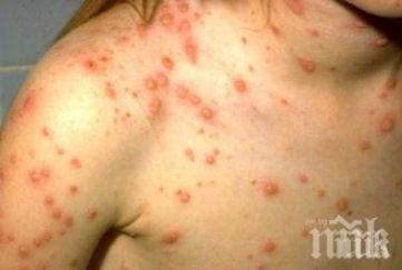 епидемията морбили скопие ескалира