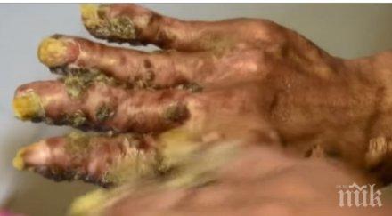 шокираща гледка човекът дърво връща болница оперират отново видео