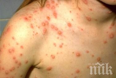 ЕПИДЕМИЯ: Издирват още хора били в контакт с болни от морбили
