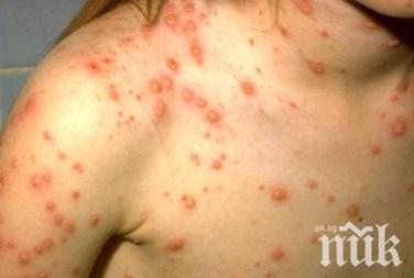 СПЕШНИ МЕРКИ: Поставят ваксини в София срещу морбили