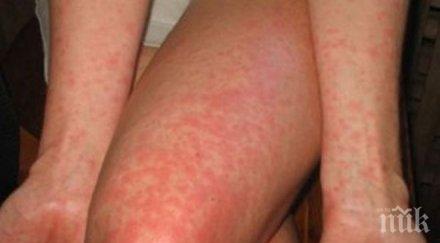 епидемията расте случая морбили благоевградско