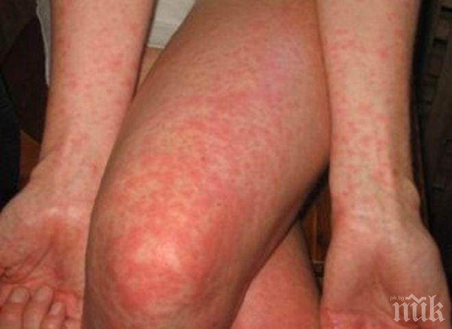 ЕПИДЕМИЯТА РАСТЕ: Нови 8 случая на морбили в Благоевградско