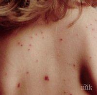 ОБРАТ: Няма заразена с морбили жена във Варна